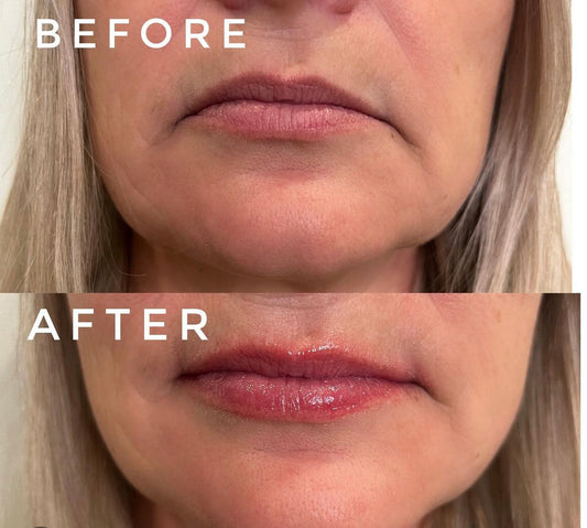 3 x Liplase laser treatment